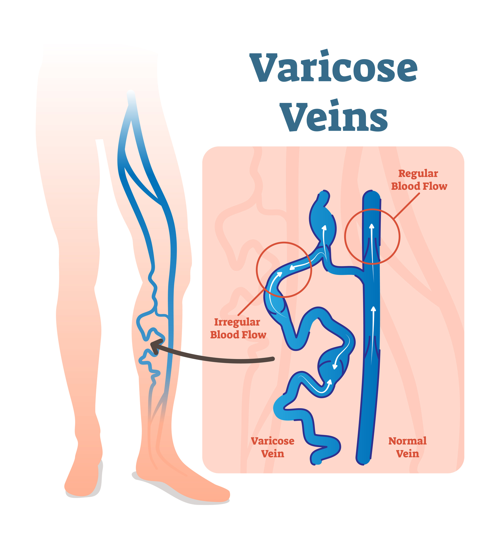 Varicose Veins Cosmetic concern or health risk LLUH News